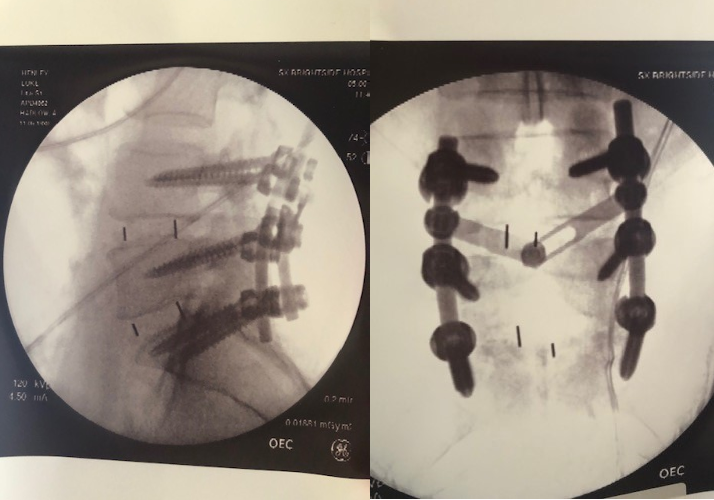 Visuals of Luke's spine post-surgery