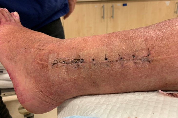 Close-up of Martin's stitched up injury