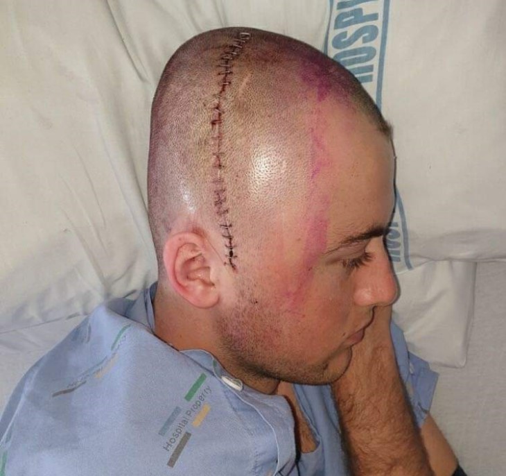 A photo of the side of Campbell Gray's head, showing the line of stitching after surgery.