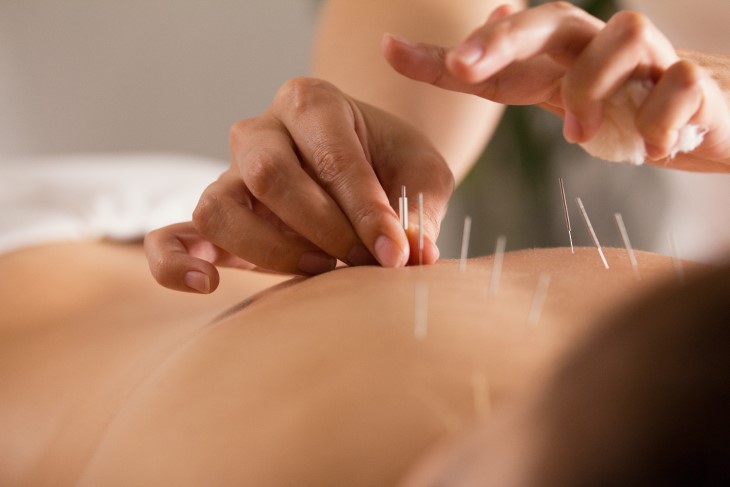 A patient receiving acupuncture treatment on their back. 